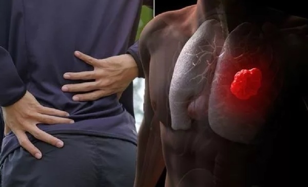 «Странная боль» в спине оказалась первым симптомом опухоли легких